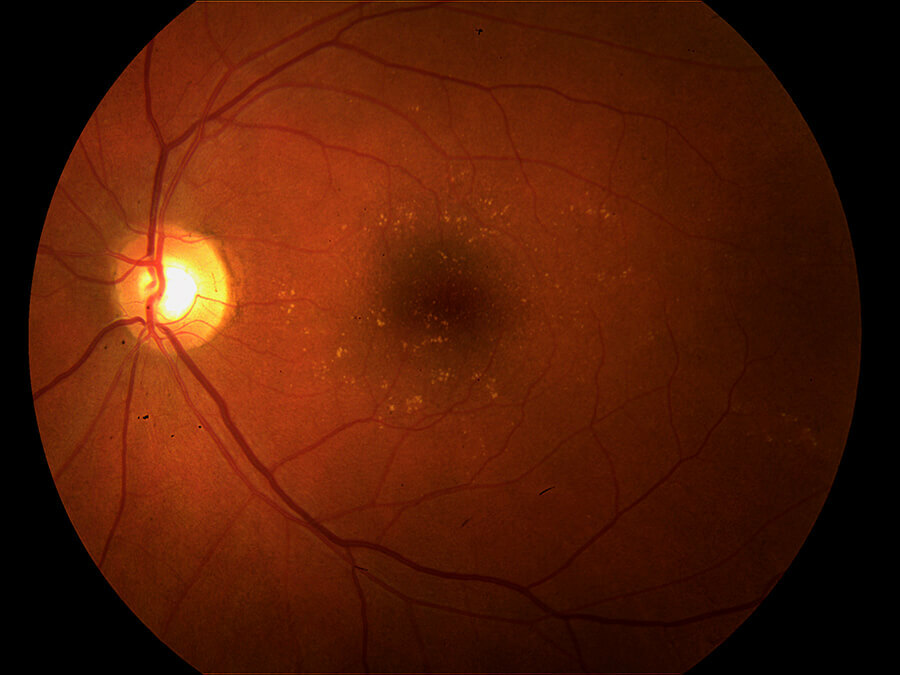 Macular Degen Pic